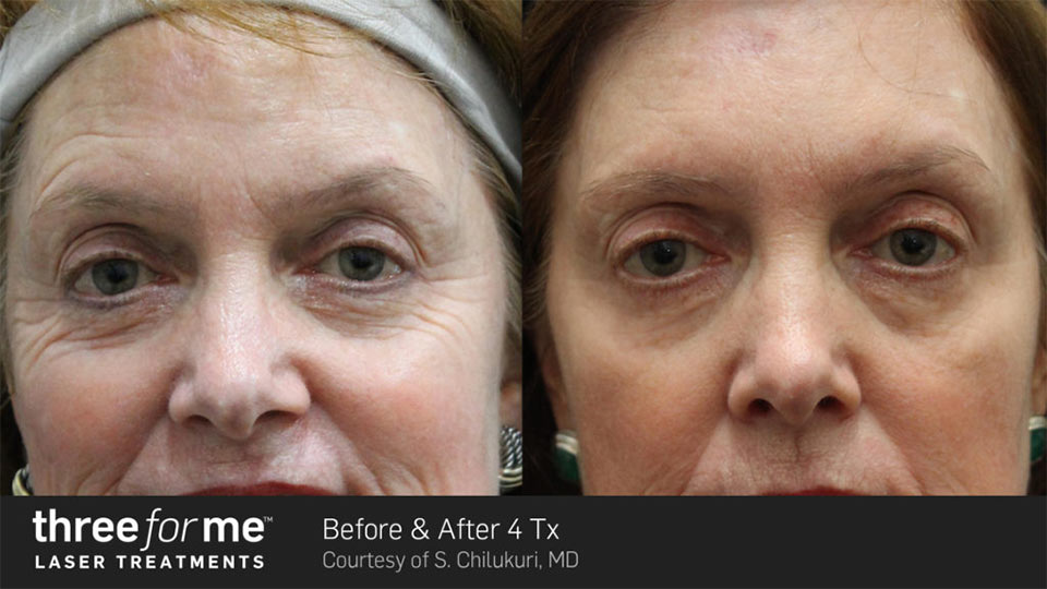 Three for me before & after | Ideal Wellness & Aesthetics